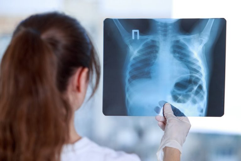 UK COVID-19 study reveals ‘hidden’ lung damage