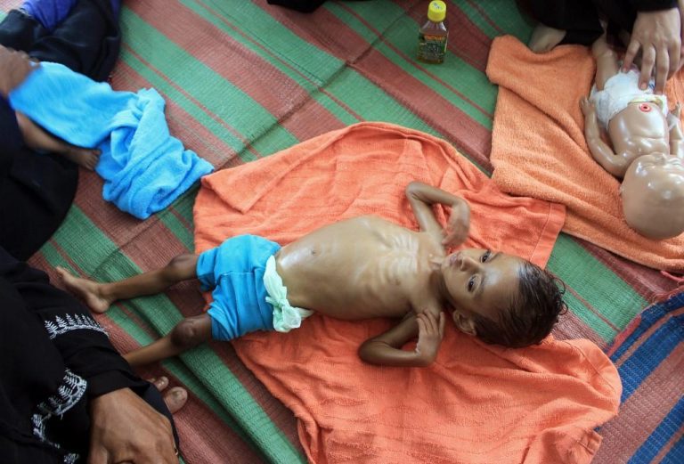 Half of Yemen under-5s face acute malnutrition: UN
