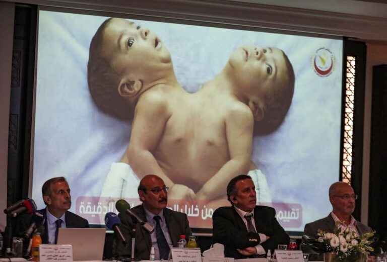 Yemen conjoined twins ‘like any child’ after separation in Jordan