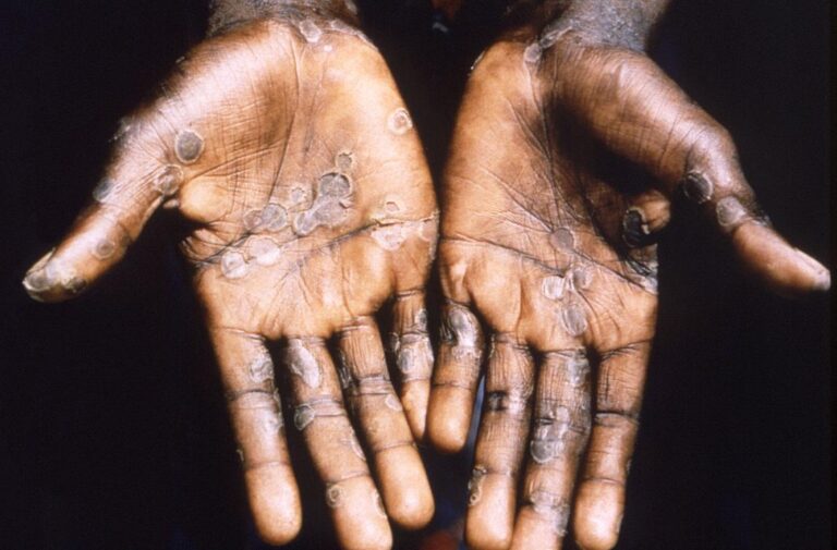 WHO working on more monkeypox guidance as cases rise — senior adviser