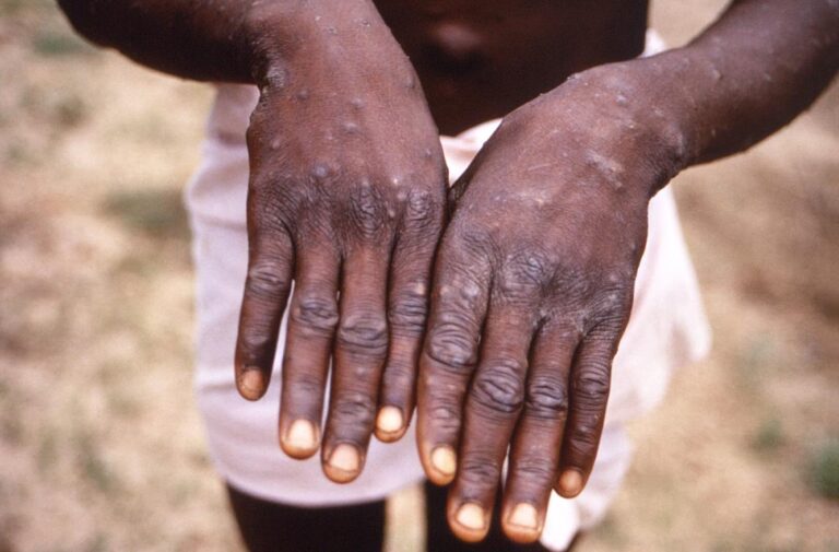 WHO: 780 monkeypox outbreak cases